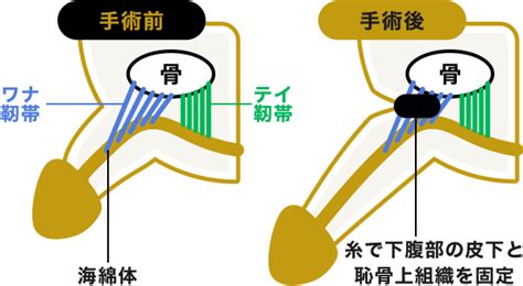 改造チンポとは|長茎術・増大術の症例写真を専門医が年齢別（20代〜70代まで…